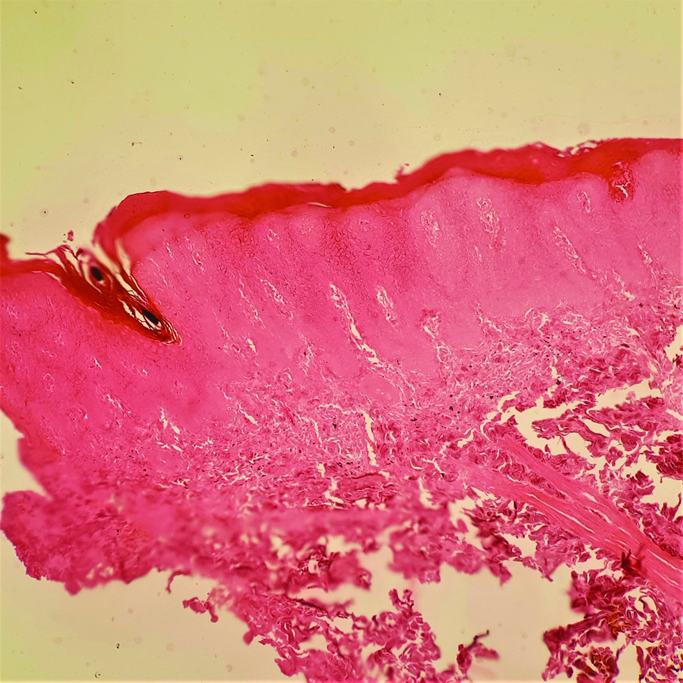 Histopathology with special stain Masson Fontana shows loss of pigment and melanocytes in epidermis (Masson Fontana ×100)