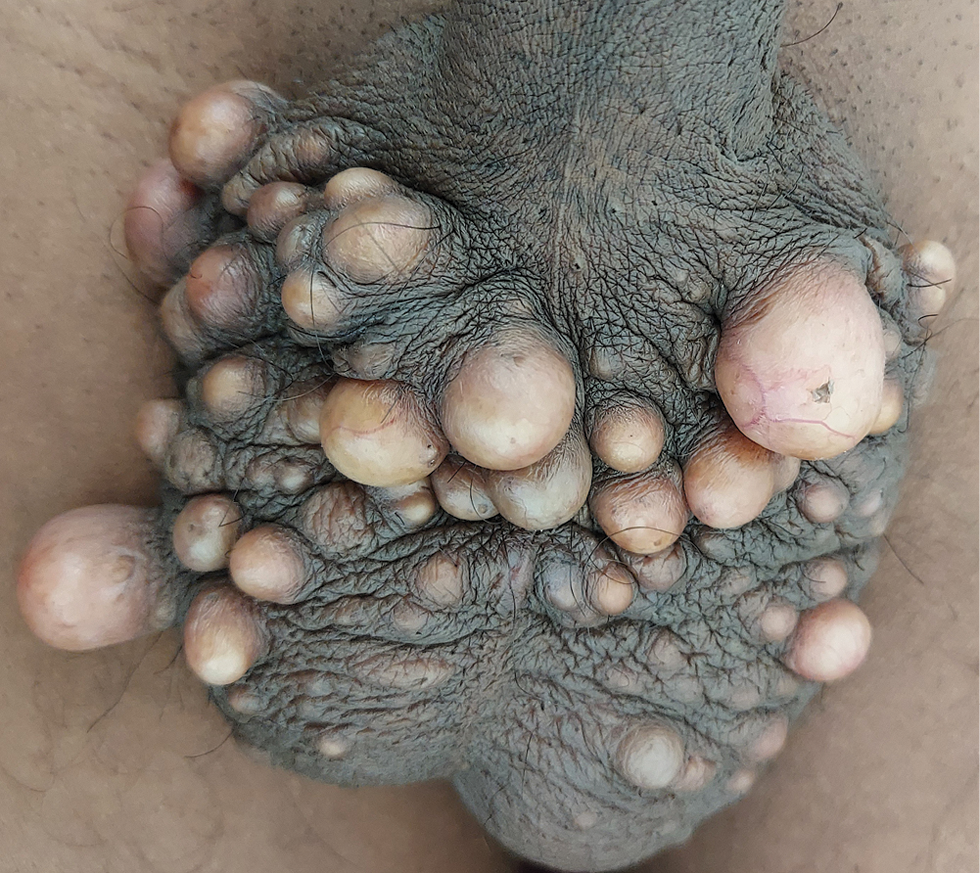 Multiple nontender discrete and confluent, white-yellowish firm subcutaneous nodules measuring 0.2-2.5 cm in diameter attached to the scrotal skin.