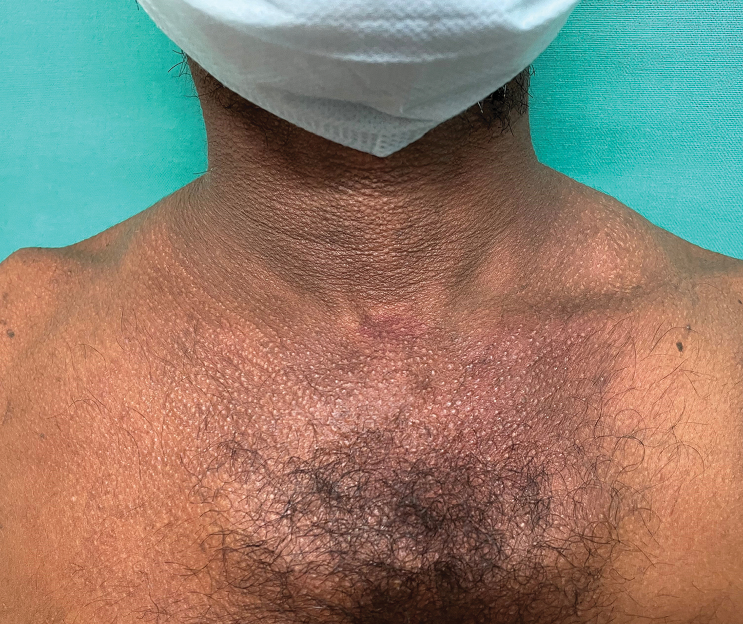 Multiple, skincolored to yellowish, small (1-3 mm) papules arranged in parallel rows over neck, supraclavicular area, and chest.