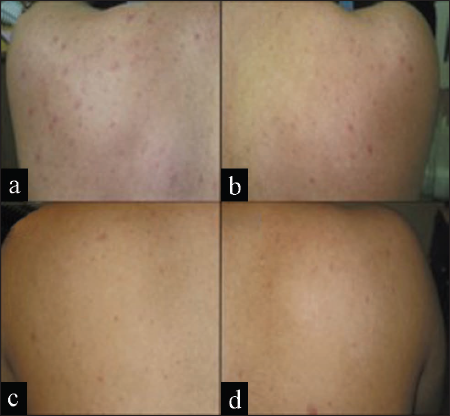 LMB-PDT side before and after treatment (a, b), IPL-treated side before and after treatment (c, d). Both sides of the face showed moderate improvement after three sessions 1 week in between (Moftah et al., 2016).[78]