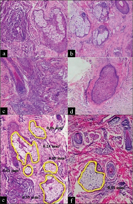Skin biopsy specimens before and after IPL. The inflammatory infiltrate after IPL is significantly decreased (b, d, f) when compared to baseline biopsies (a, c, e). Histometry of skin biopsy specimens (e, f) showing significant decrease in surface area of sebaceous glands after IPL (f) when compared to baseline biopsies (e) (H&E; 3100) (Barakat et al., 2017).[77]