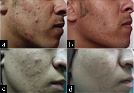 Clinical evaluation of acne vulgaris patients in response to IPL. Representative photographs of face (a-d) before (a, c) and after IPL (b, d) (Barakat et al., 2017).)[77]