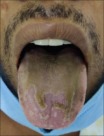 Confluent, hair-like projections over the dorsum of the tongue with a brown-black carpet-like appearance.