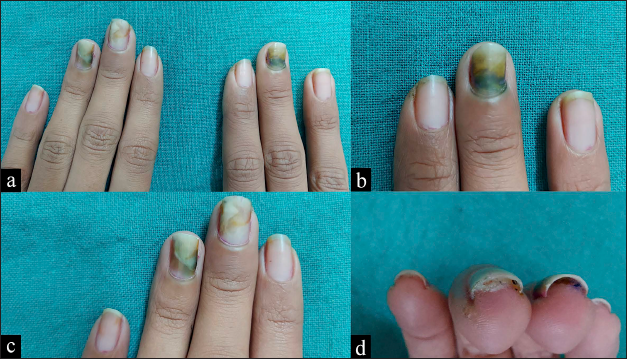 Proximal greenish-black discoloration, distolateral onycholysis, and proximal paronychia seen over (a) both middle fingernails and left ring fingernail. (b) Close-up view of right middle fingernail. (c) Close-up view of left middle and ring fingernail. (d) Mild pus discharge from undersurface of left middle fingernail.