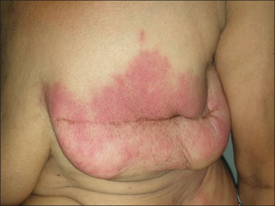 A well-demarcated, erythematous, and indurated plaque present over the left breast.