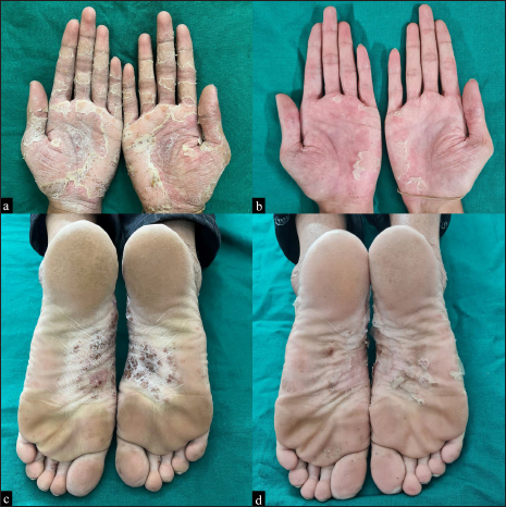 Multiple pustules over well-defined, erythematous, scaly plaques with dried lakes of pus on his bilateral palms (a) at baseline and (b) after treatment with topical clobetasol propionate 0.05% for 2 weeks. Similar lesions over the soles (c) at baseline and (d) after treatment with topical clobetasol propionate 0.05% for 2 weeks.