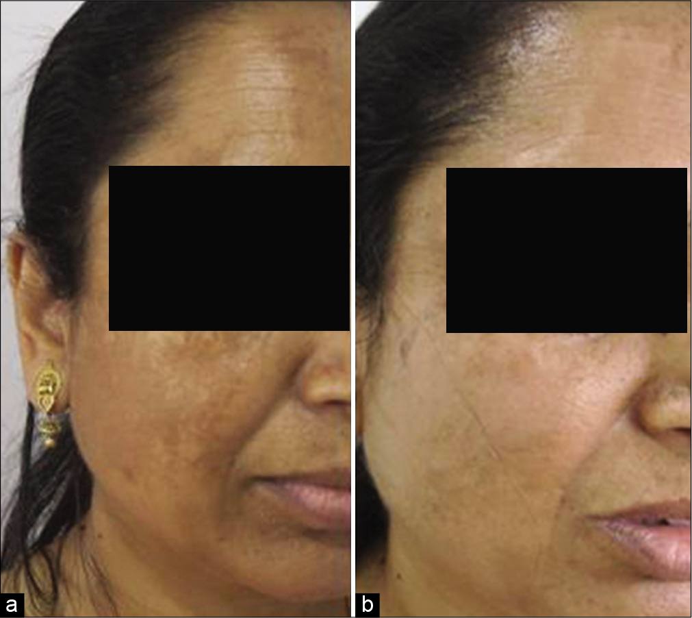 (a) Baseline melasma (b) after two sessions of combination glycolic peel and one session of SSR 540 laser along with conventional treatment of melasma and nutritional support with a significant improvement in MASI score.