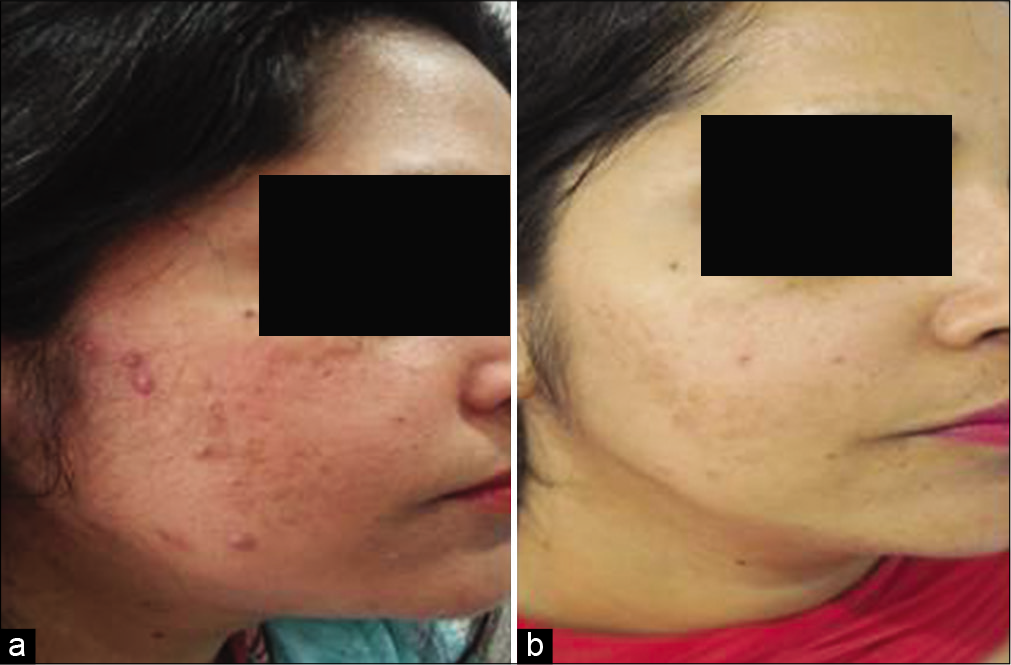 (a) Baseline pictures – melasma with steroid-induced acneiform eruptions and rosacea (b) after three sessions of SSR540 laser and conventional treatment along with nutritional support.