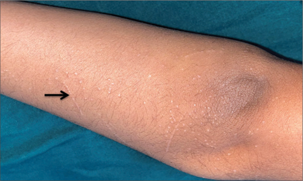 Multiple shiny flat-topped hypopigmented to mildly violaceous papules few present in linear pattern exhibiting Koebner (black arrow) phenomenon over upper limbs, trunk, and neck.