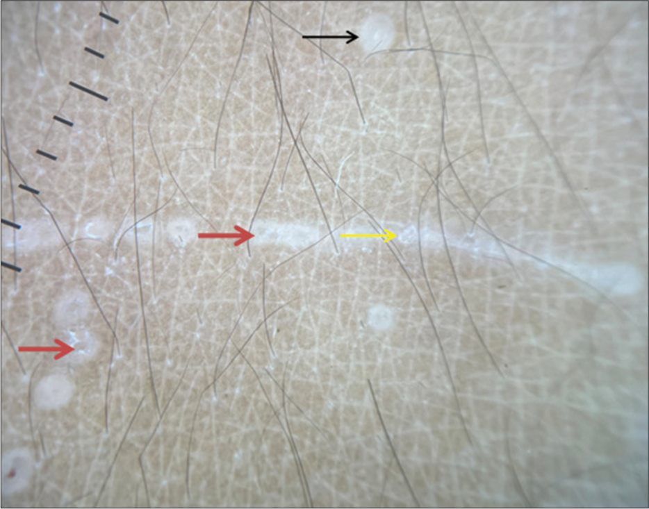 Dermoscopy (DermLite DL4; 3Gen; San Juan Capistrano, California, USA, noncontact polarized mode, ×10 magnification) showed multiple, white, and well-circular areas (black arrow) with whitish scales (yellow arrow), along with central brown shadow (red arrow) within white circular areas.