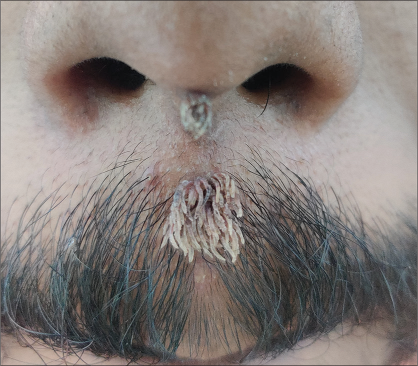 Filiform papules of size 2 mm and 5 mm noted over tip of the nose and philtrum of the upper lip, respectively.