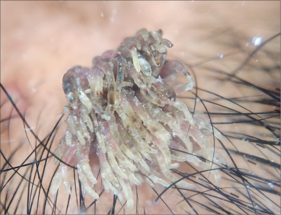 Folarized dermoscopy of the lesion revealed a filiform feature similar to Dahlia flower with a tapered finger pattern, a keratotic white tip, and pigmented zones.