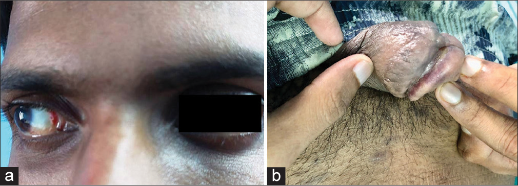 (a) Erythematous papules on medial canthi and (b) violaceous plaque on glans penis.