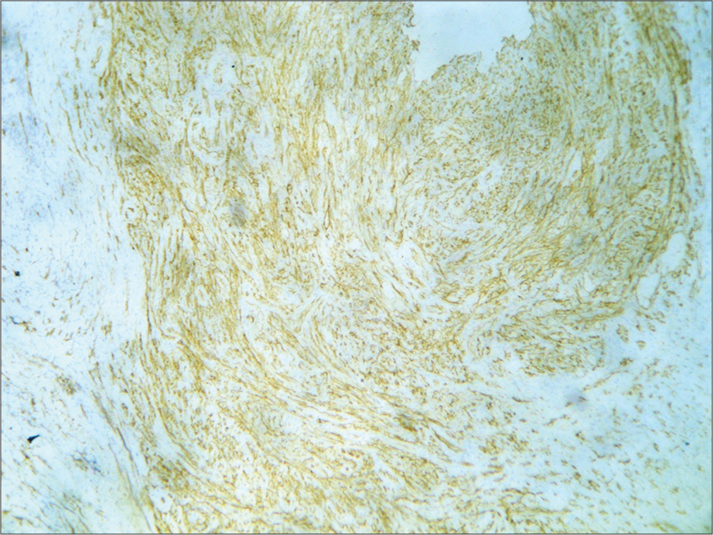 Immunohistochemistry (IHC) showing vascular spaces staining positive for CD34, IHC stain ×400.