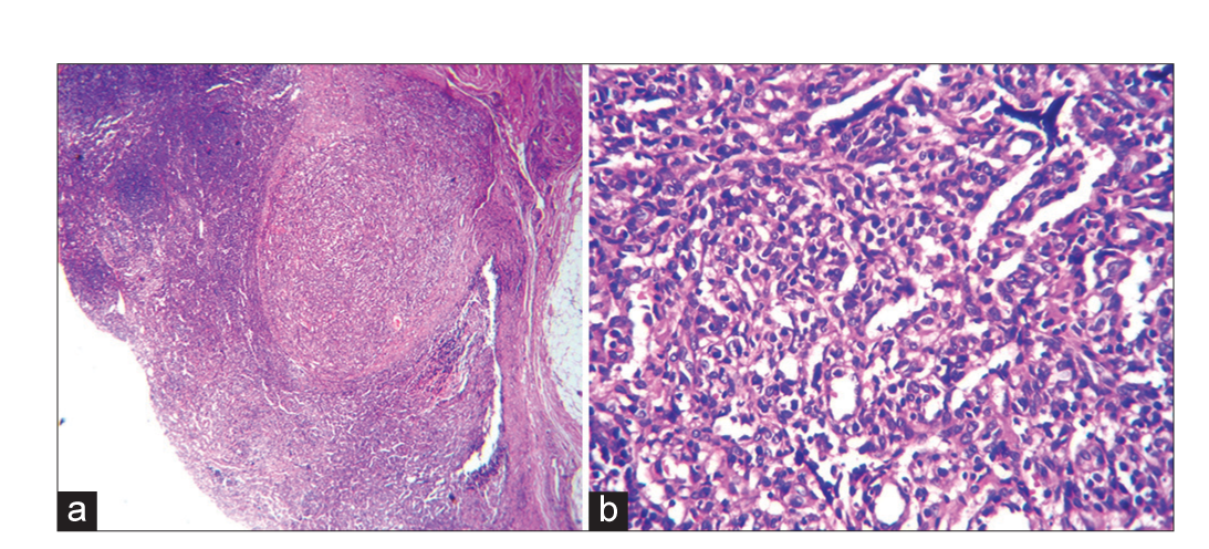 (a) Lymph node biopsy showing architexture effaced by multiple vascular spaces, H & E, 100, high power showing and (b) high power showing vascular spaces with plump endothelial cell, H & E, ×400.