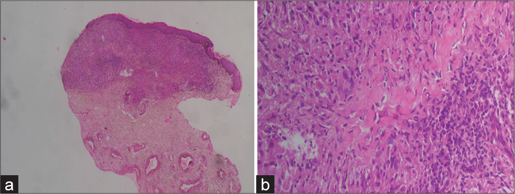 (a) The histopathology section showing granulomatous changes around degenerated collagen (Hematoxylin and Eosin stain ×10). (b) The histopathology section showing necrobiotic collagen with palisade of histiocyte surrounding it (Hematoxylin and Eosin stain ×40).