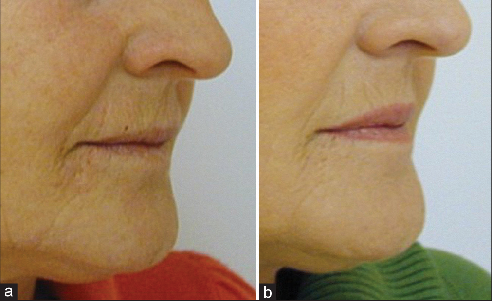 Treatment to elevate drooping corners of the mouth. (a) before treatment, (b) after 4 carboxytherapy sessions.