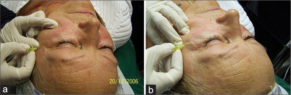 Injection in the upper eyelid (a) and the lower eyelid (b).