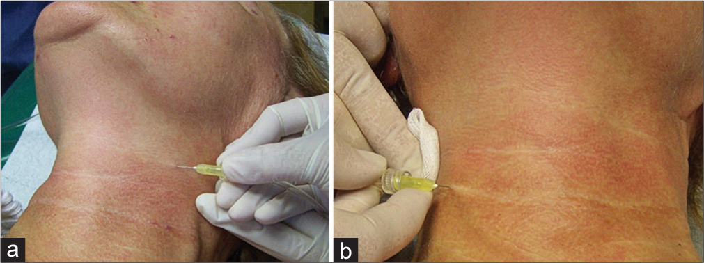 Treatment of the neck with gas administration outside the wrinkle (a) and along the wrinkle (b).