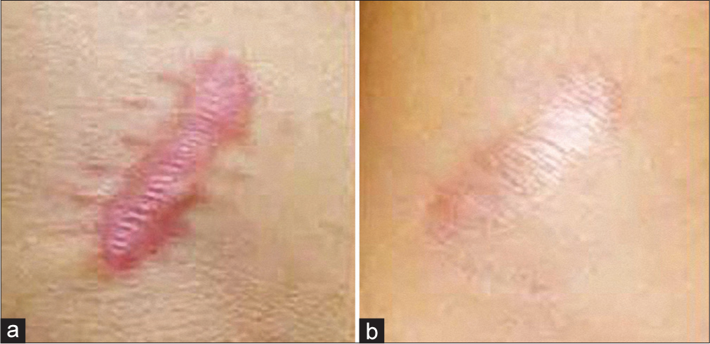 Effect of injection carboxytherapy on a fresh hypertrophic scar: (a) Before treatment and (b) after five sessions – flattening of the lesion and complete remission of erythema.