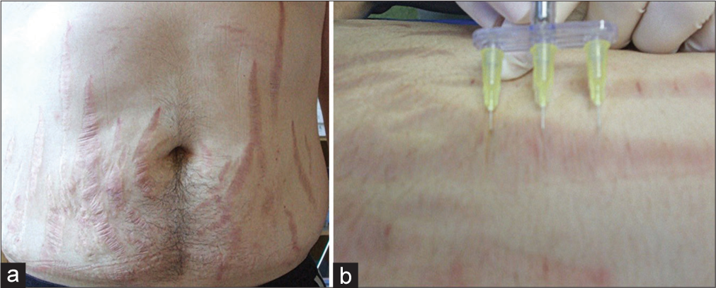 Possible use of a comb applicator in stretch mark treatment. (a) Multiple abdominal stretch marks. (b) Use of a comb applicator.