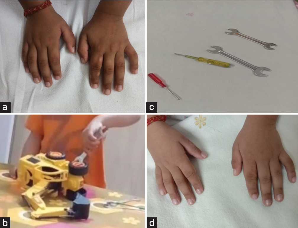 (a) Multiple calluses on both hands, (b) child playing with tools, (c) tools used (screwdriver, spanner). (d) After 3 months follow-up, near-complete remission of callosities seen.