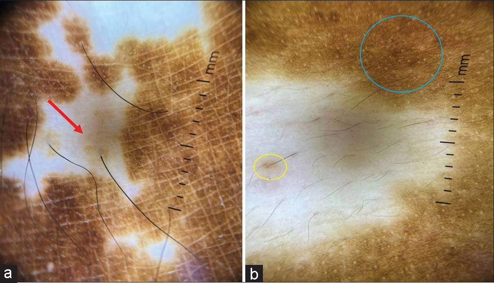 (a and b) Dermatoscopy (Non-polarised Dermlite 4 ×10) of depigmented macule shows white glow, starburst pattern (red arrow), perifollicular pigmentation (yellow circle), trichome sign, and tapioca sago sign (blue circle).