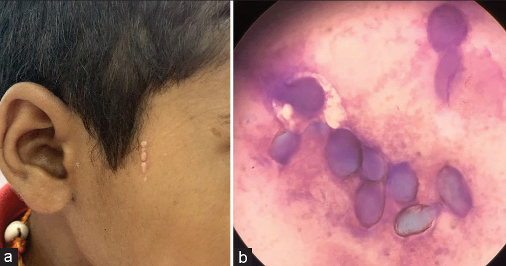 (a) Skin-colored shiny pearly white umbilicated papules over the zygomatic area with pseudo-koebnerization evident, (b) Tzanck smear with molluscum bodies.