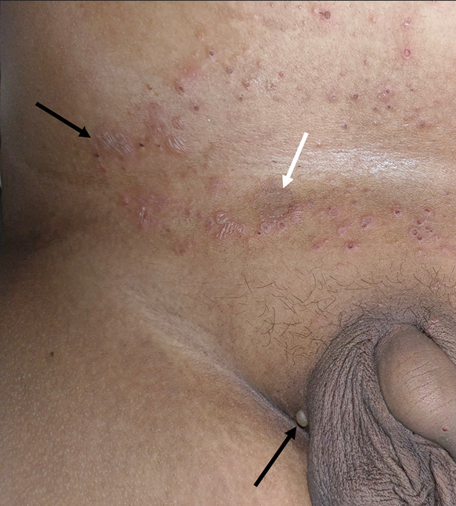 Multiple flaccid fluid-filled vesicles and bulla in the lower abdomen and groin (Black arrows). A single scaly annular plaque with central clearing (white arrow).