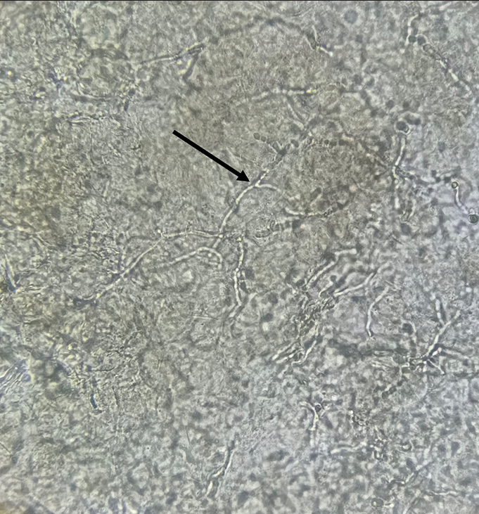 10% potassium hydroxide mount under ×40 magnification showing long, thin, slender, branched, and septate hyphae.