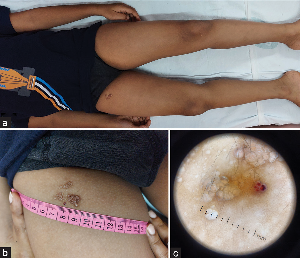(a and b) showing the location of the fluid-filled vesicles over the right anterior thigh, without any background of ill-defined swelling and (c) shows the dermoscopic appearance of fluid-filled lacunae with a single vesicle showing blood-tinged fluid content.
