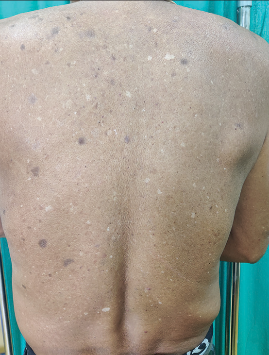 Clinical image of the back of an elderly male showing cutaneous changes of photodamage characterized by multiple seborrheic keratoses, well-defined hypopigmented macules (idiopathic guttate hypomelanosis), and ill to well-defined hyperpigmented macules on the background of generalized xerosis.