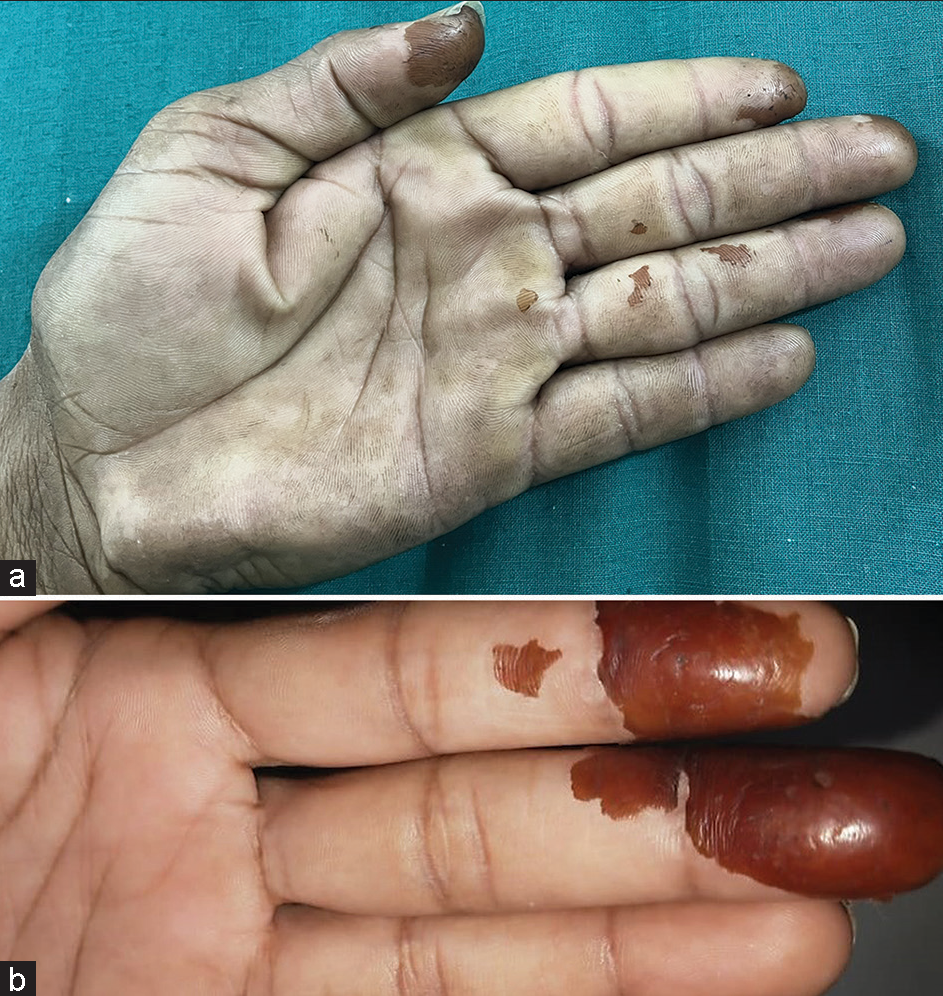 (a and b) Well-demarcated brownish macules over palms suggestive of cashew nut dermatitis.