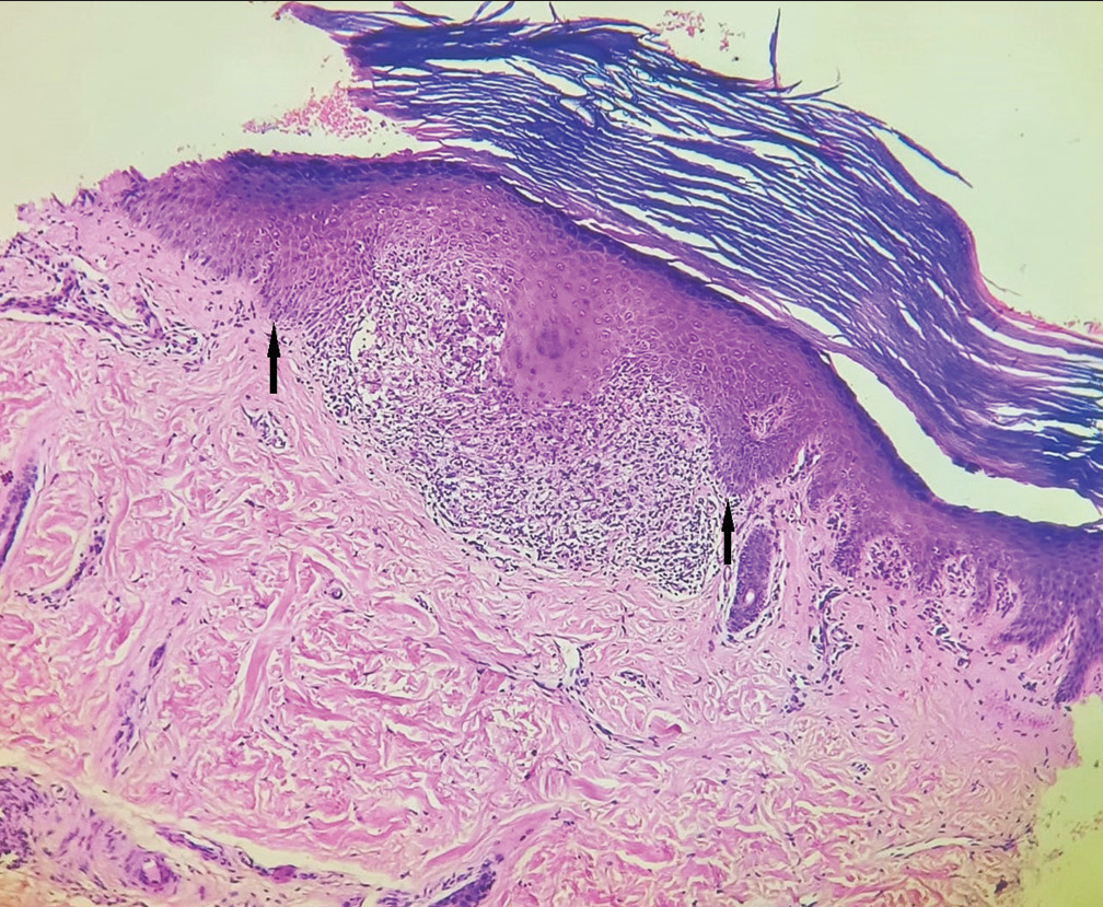 Skin biopsy showing hyperkeratosis, irregular acanthosis with rete pegs “clutching” mononuclear infiltrate in the upper dermis, H and E × 100.