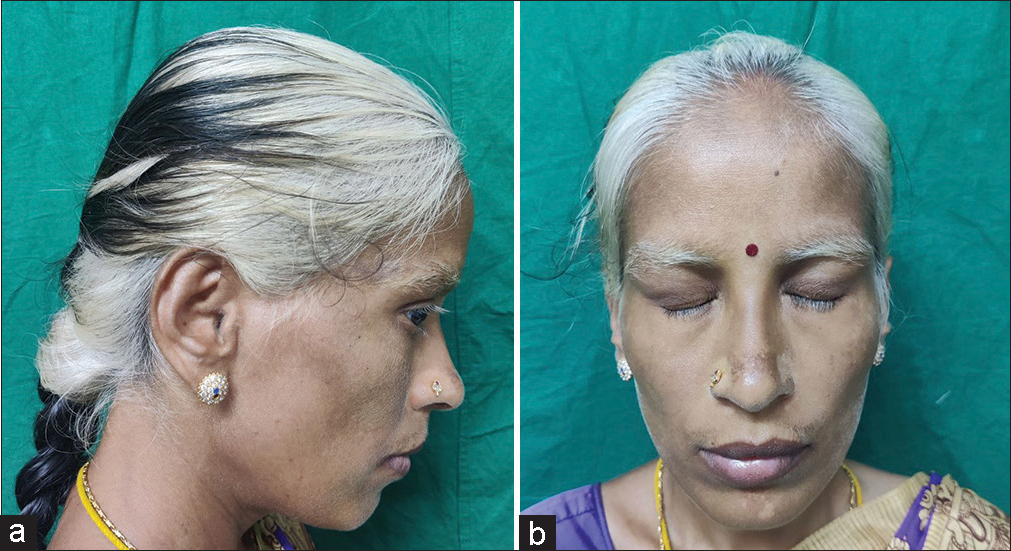 (a and b) Diffuse whitening of scalp hair noted along with eyebrow and eyelash poliosis.