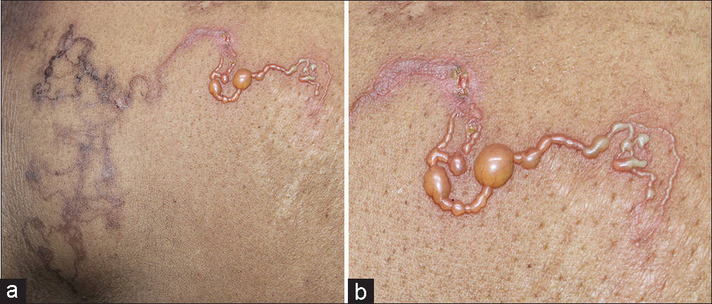(a) Serpiginous linear eruptions over the abdomen. (b) “String-of-pearls” appearance of the serpiginous tract with overlying vesiculation and bullae.