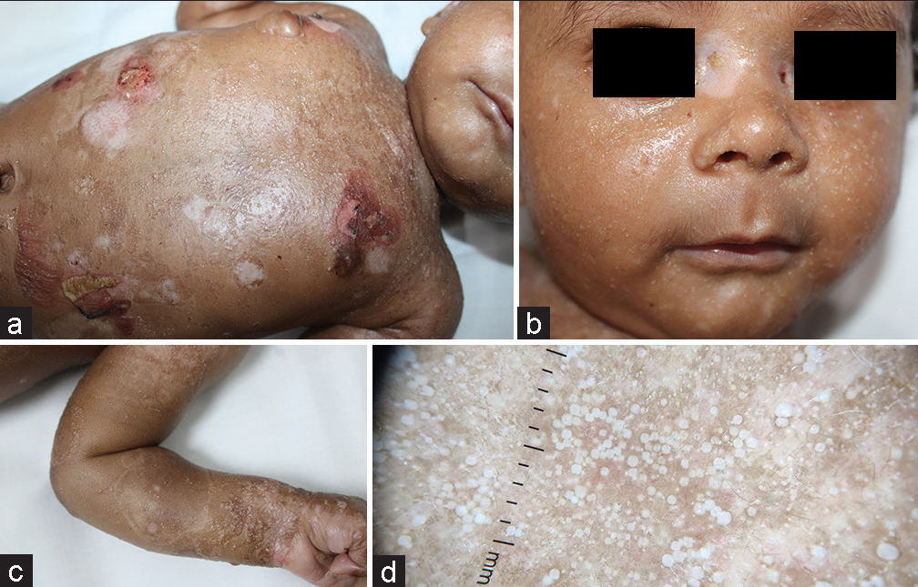 (a) Multiple eruptive milia with milia en plaque noted over the chest, face, forearm. (b) Multiple eruptive milia noted over the face. (c) Multiple eruptive milia noted over the forearm. (d) Dermoscopy showing multiple monomorphic pearly white papules of milia (Dermlite DL 4, ×10).