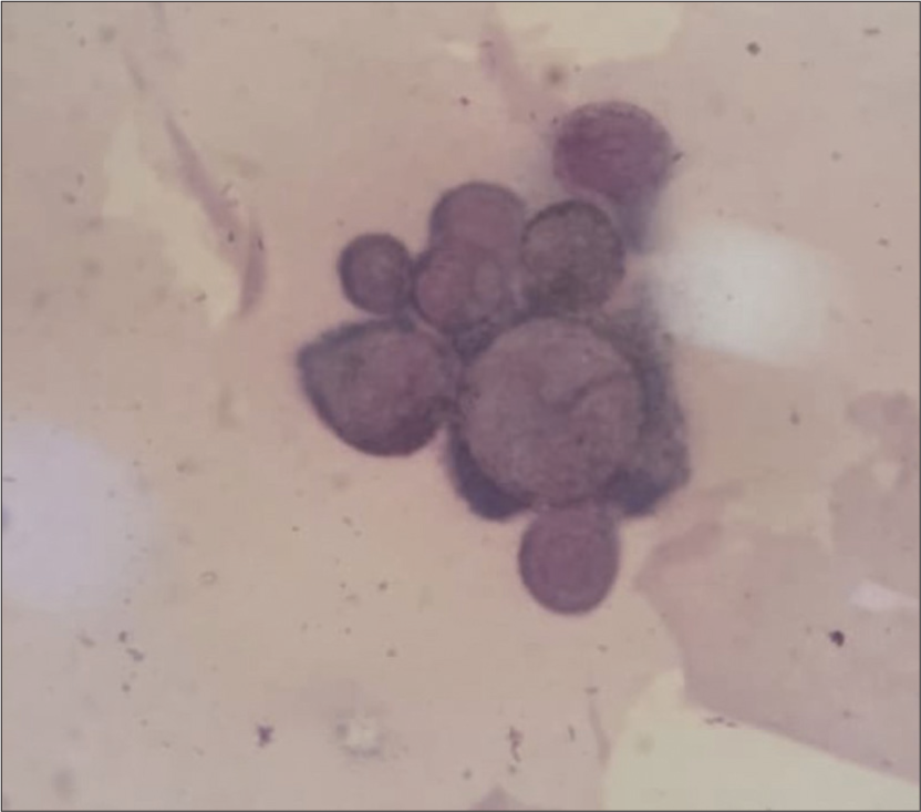 Tzanck smear showing multinucleated giant cells.