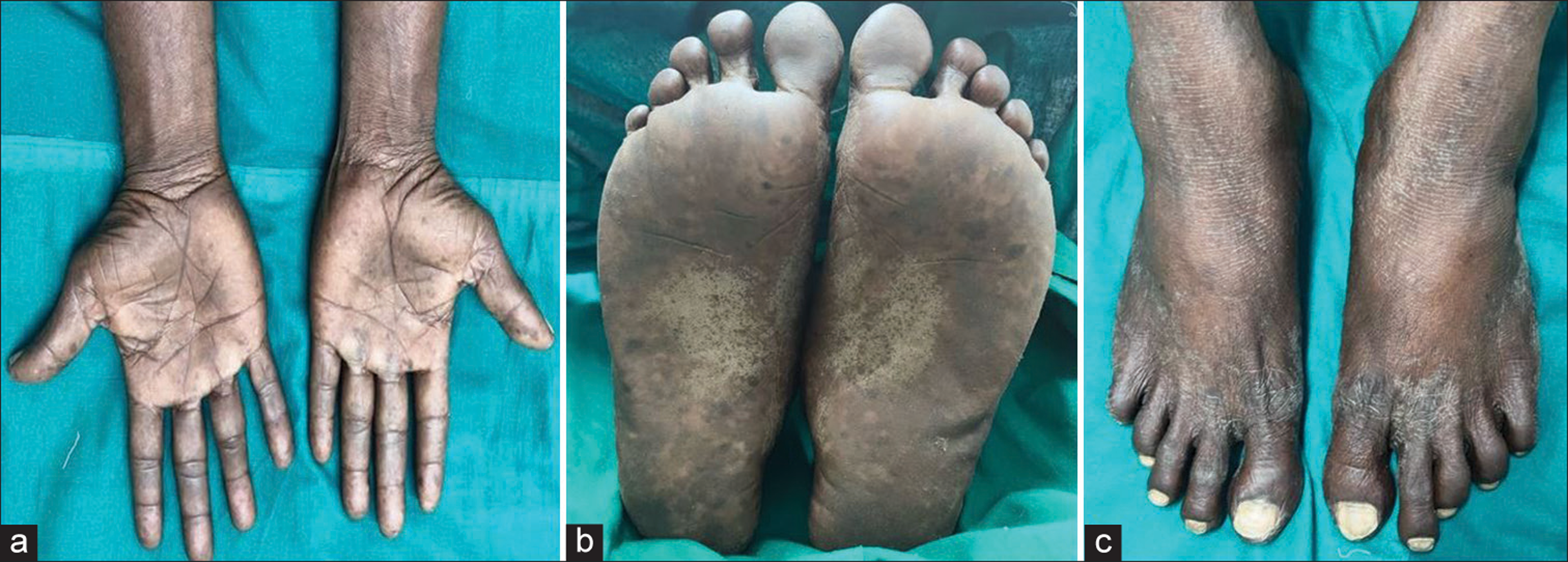 (a-c) Diffuse erythema over the palms and soles with accentuation in areas of weight-bearing and additional areas of hyperkeratosis and focal desquamation in the soles with extension to the dorsum of toes.