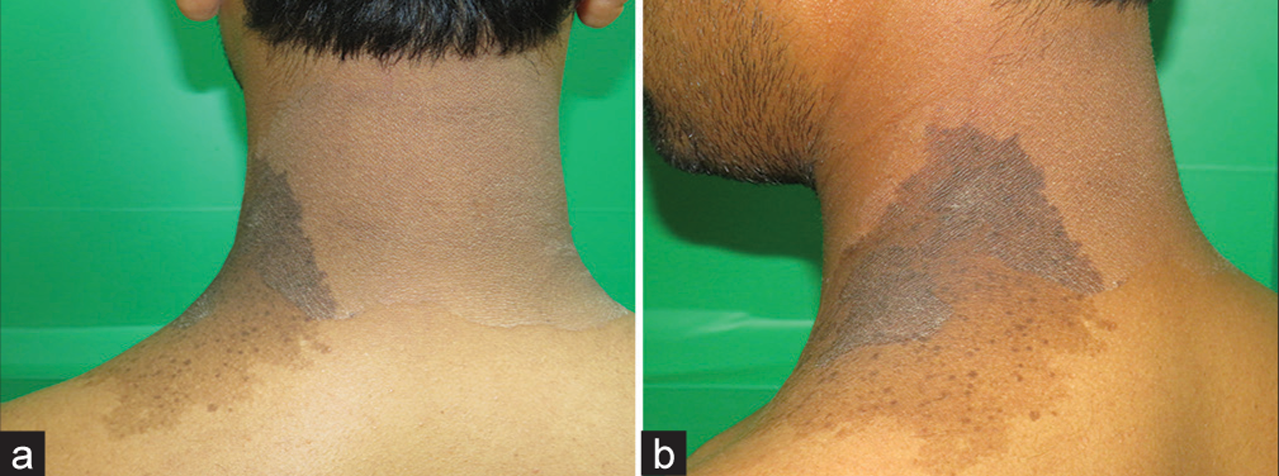 (a) Hypopigmented patch of pityriasis versicolor over the posterolateral neck along with nevus spilus. (b) The overlapping area of pityriasis versicolor and nevus spilus showing hyperpigmentation suggestive of the pigment boosting phenomenon.