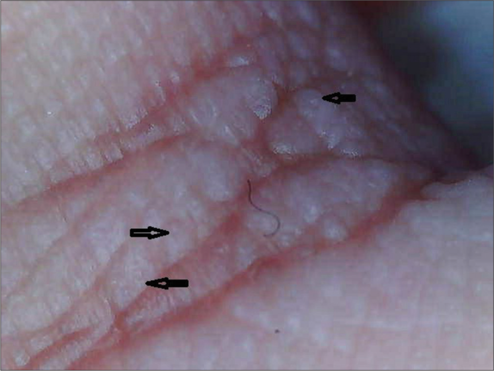 Dermoscopy (Dino-Lite AM2111) showing dilated sweat duct openings (×40), black arrows.