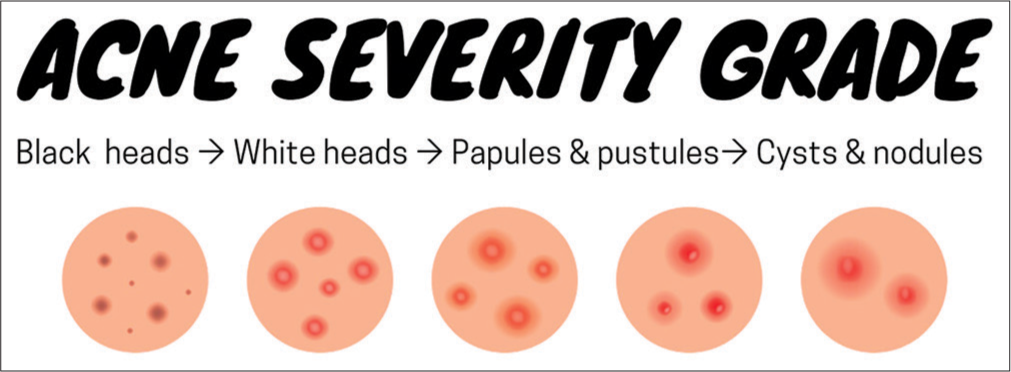 Acne severity grade: It ranges from mild-to-moderate-to-severe, respectively, Illustrated by Asif S.