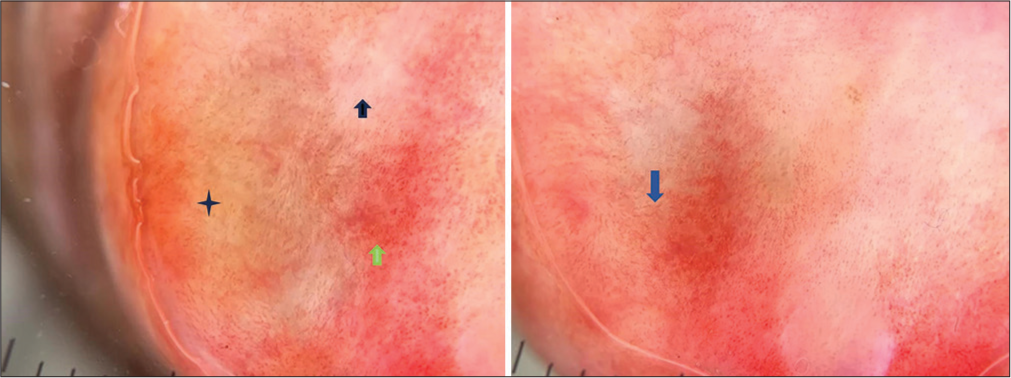 Reddish-orange structureless (black asterix), curved vessels (green arrow), yellow-white areas (black arrows), and serpentine vessels (blue arrows).