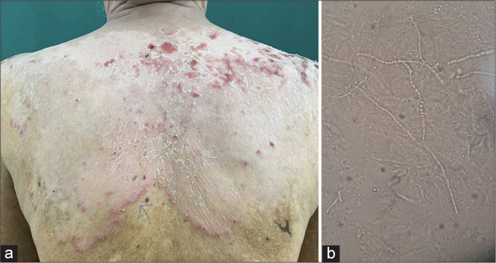 (a) Depigmented macule over the upper back with erythematous raised active border studded with pustules. (b) Fungal elements on potassium hydroxide 10% mount.