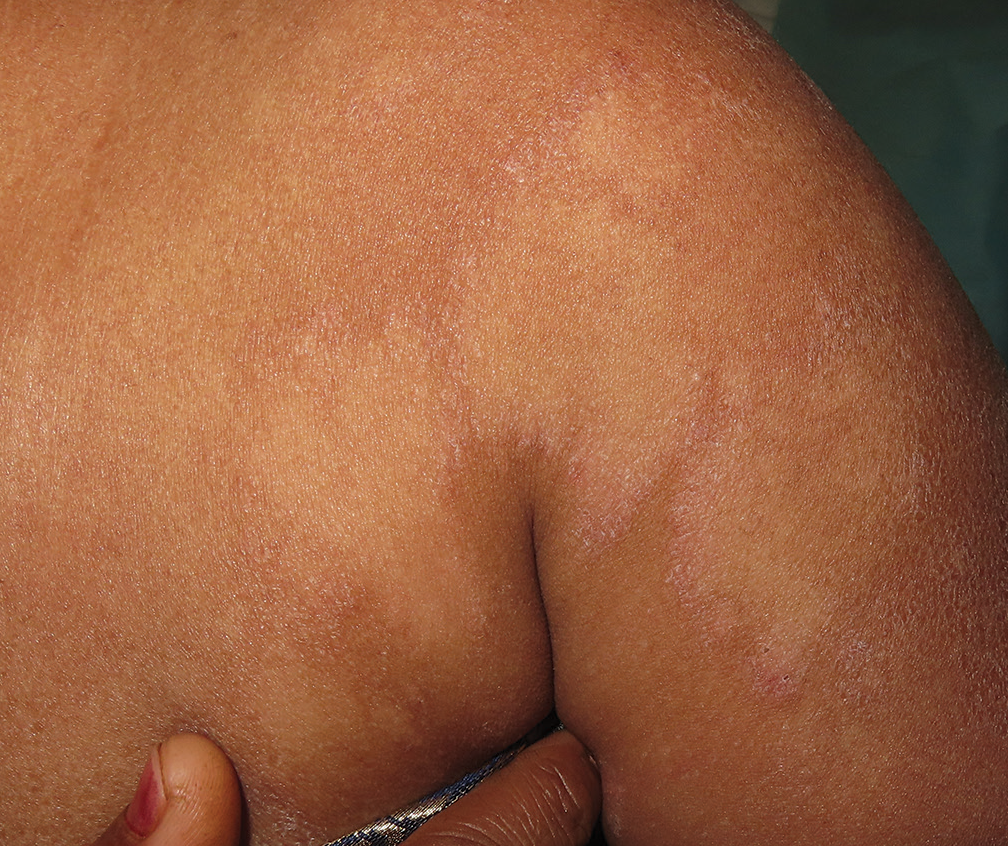 Clinical image shows annular plaques with erythematous scaly margin and central hypopigmentation. Note the gigantic plaque measuring 10 × 8 cm.