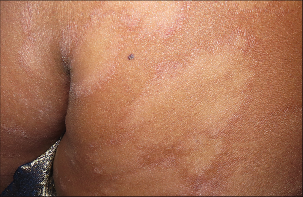 Multiple large annular erythematous plaques with central hypopigmentation and scaling at the periphery.