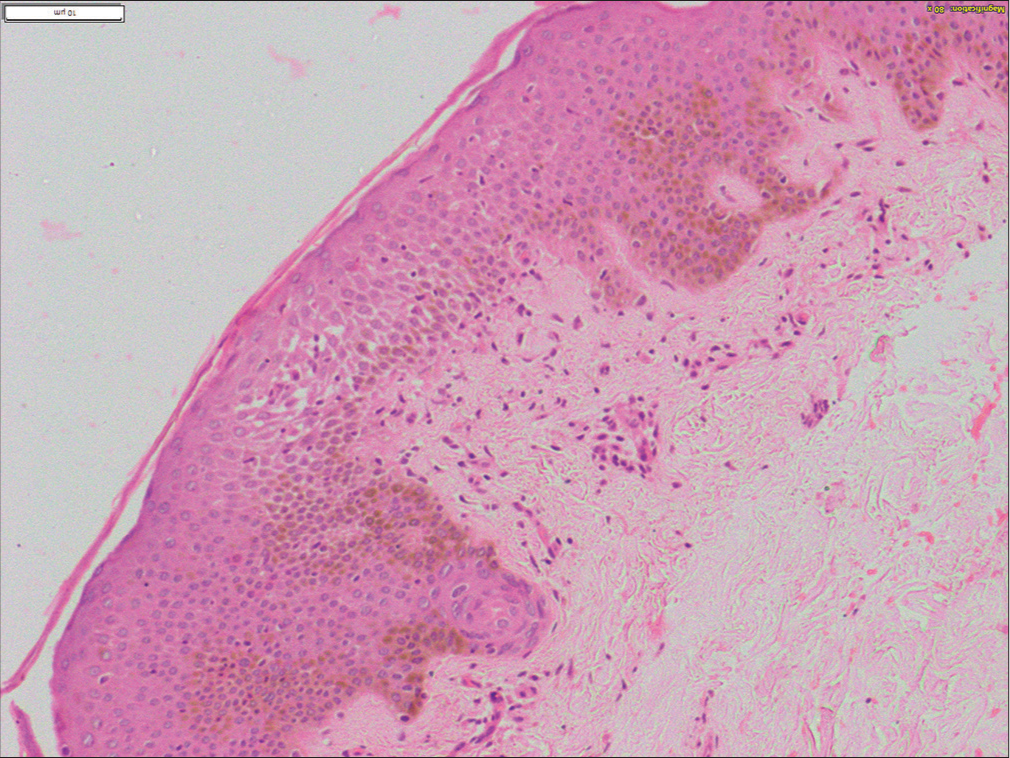 Histopathological image shows acanthotic epidermis with lymphocytic exocytosis, spongiosis, hypogranulosis, and focal intraepidermal erythrocytes. Dermis shows mild perivascular lymphocytic infiltrate and extravasated erythrocytes (H and E, ×400).