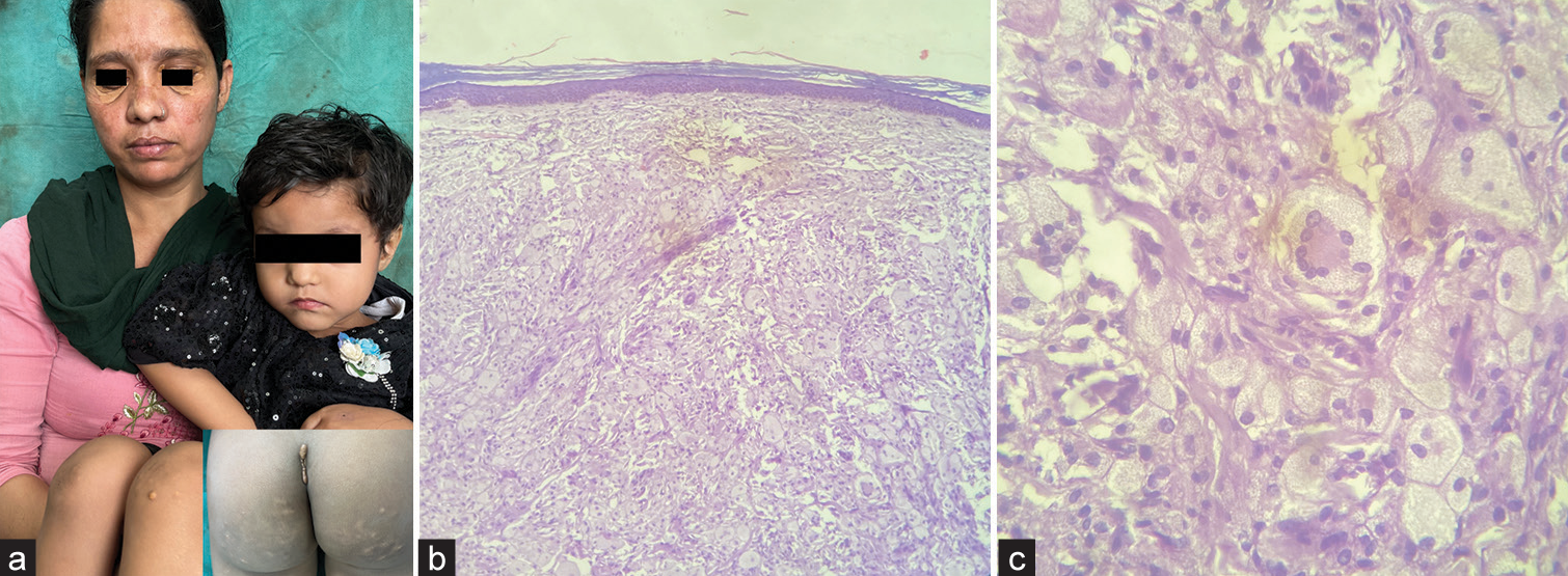 Clinical image. (a) Daughter shows multiple yellow papules over the bilateral knees, legs, and gluteal cleft (Inset); and mother shows periorbital yellowish flat plaques. Histopathology showing (b) thin epidermis, flattened rete ridges, and lymphoplasmacytic infiltrate in dermis and subcutis (H and E × 100). (c) Lymphoplasmacytic infiltrate and Touton giant cells (H and E × 400).