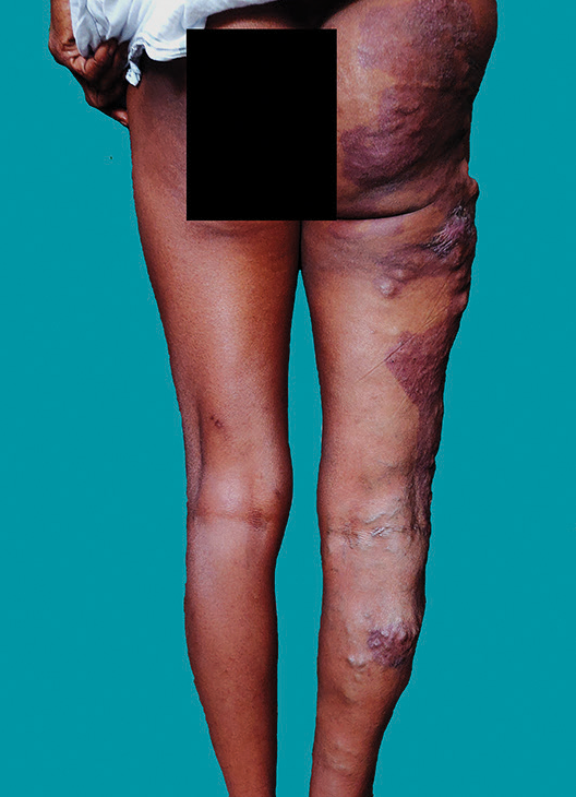 Non-blanchable dull erythematous stain with a geographical margin noted extending from the right buttock to the right midcalf. Dilated and tortuous veins were noted over the right buttock and posterolateral thigh extending to the leg.