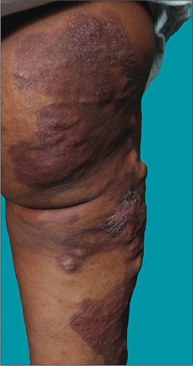 Grouped papules and vesicles with frog spawn appearance present over the right buttock. Dilated and tortuous veins were noted over the right buttock and posterolateral thigh.